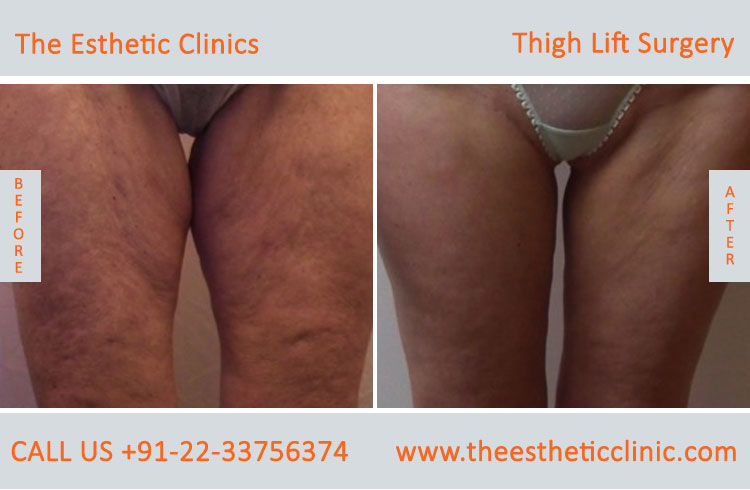 Thigh Lift Surgery, Thigh Reduction before after photos in mumbai india (2)